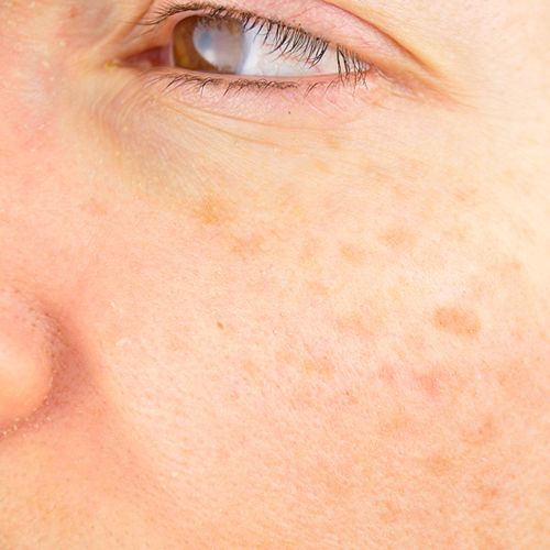 A close-up of a woman with hyperpigmentation