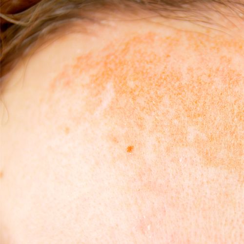 Close up on hyperpigmentation or dark spots on forehead