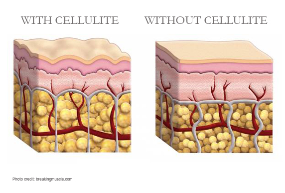 A cross-sections of skin with cellulite and without infographic