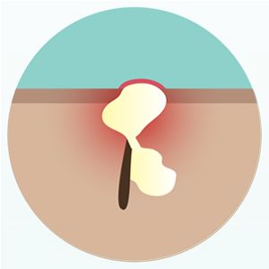 Diagram of a papule