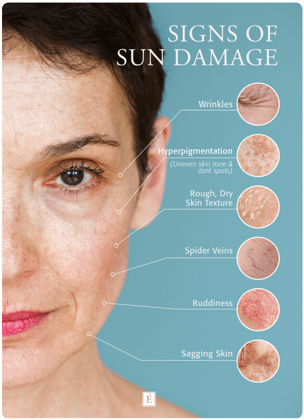 Signs of sun damage