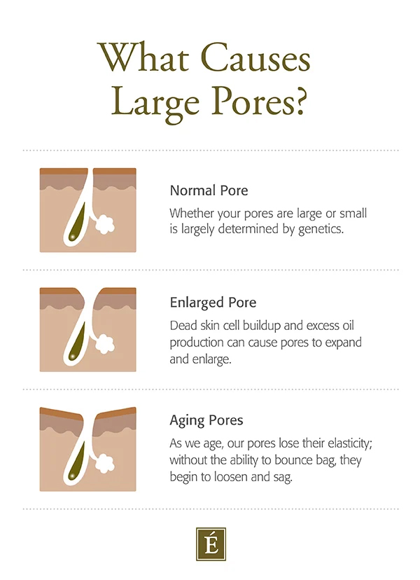 the causes of large pores