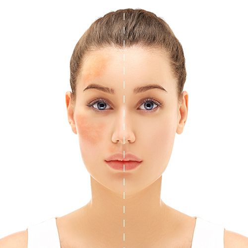 an image of a woman with a dotted line marking the middle of her face and separating the one side with melasma and the one side without