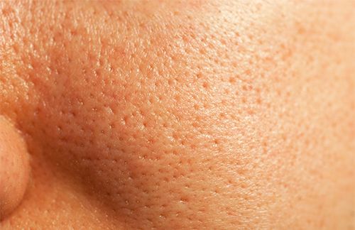 kin with large pores