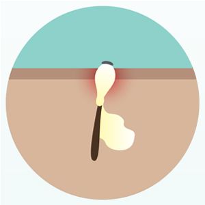 Diagram of a blackhead