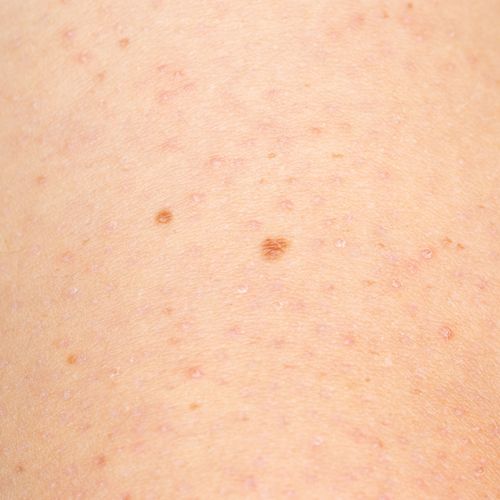 Keratosis Pilaris