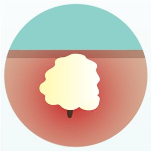 Diagram of a nodule