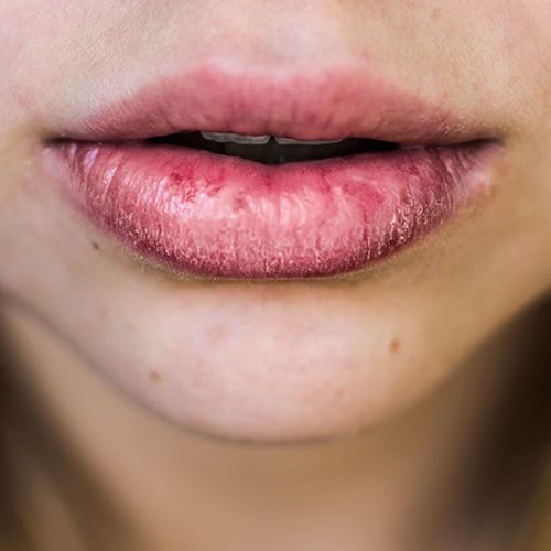 A close-up of a woman's dry chapped lips