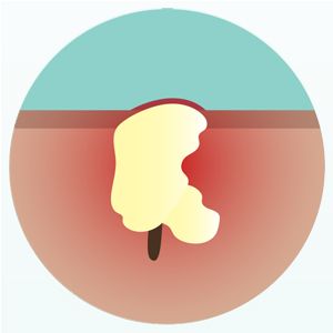 Diagram of a pustule