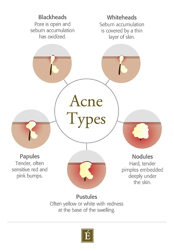 types of acne